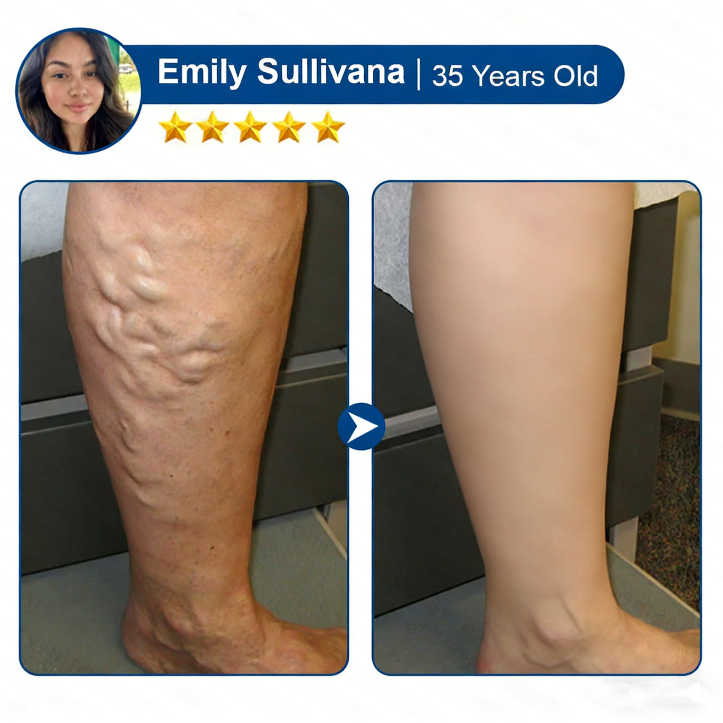 Vein ContourMicroneedle Patch with AdvancedDiosmin & Hesperidin Delivery ๐ฟ 7-Day Visible Results for VaricoseVeins