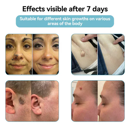 LOVILDS®  All-in-One CO₂ Laser Eraser Pen | Removes Moles, Warts, Skin Flaws & Pigmentation