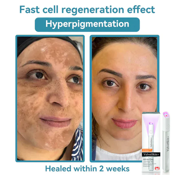 LOVILDS®  All-in-One CO₂ Laser Eraser Pen | Removes Moles, Warts, Skin Flaws & Pigmentation