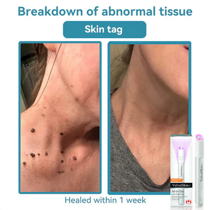 LOVILDS®  All-in-One CO₂ Laser Eraser Pen | Removes Moles, Warts, Skin Flaws & Pigmentation